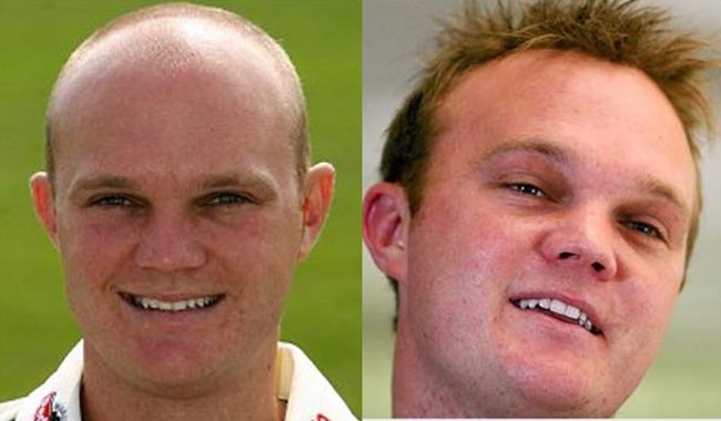 Indian Cricketers Who Seemingly Got Hair Transplant Secretly
