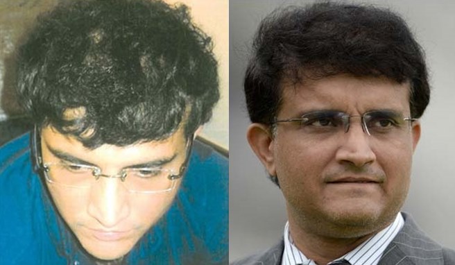 Sourav Ganguly Hair Transplant